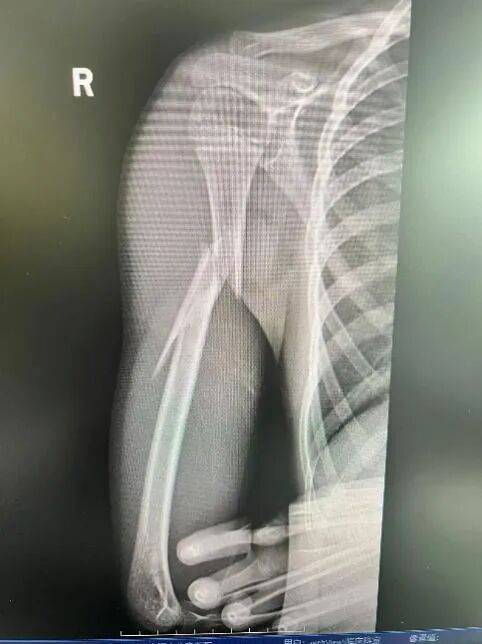 10岁男孩遭遇洗衣机“陷阱”,右臂粉碎性骨折!医生提醒